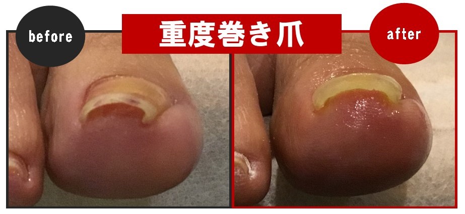 宝塚市の40代女性の巻き爪施術