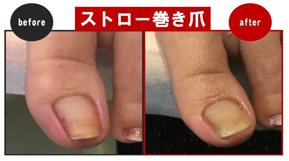 ストロー状の巻き爪