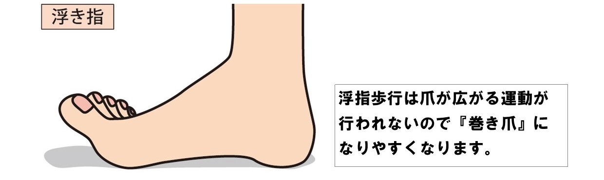 巻き爪の原因は浮指