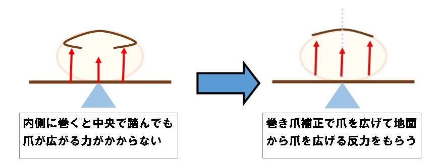 巻き爪改善の秘訣