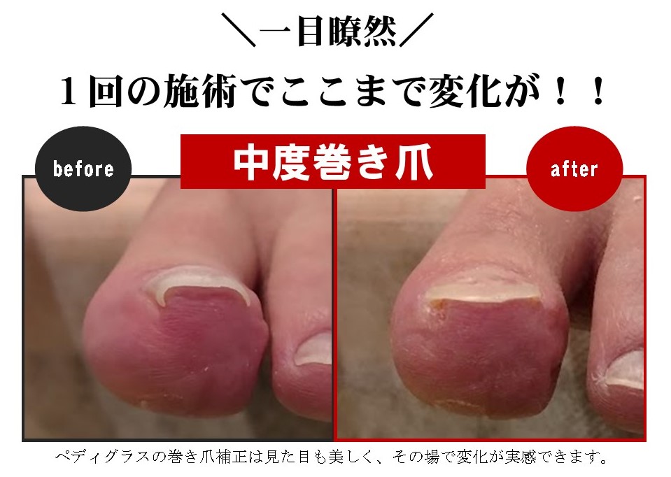 巻き爪施術一回での変化